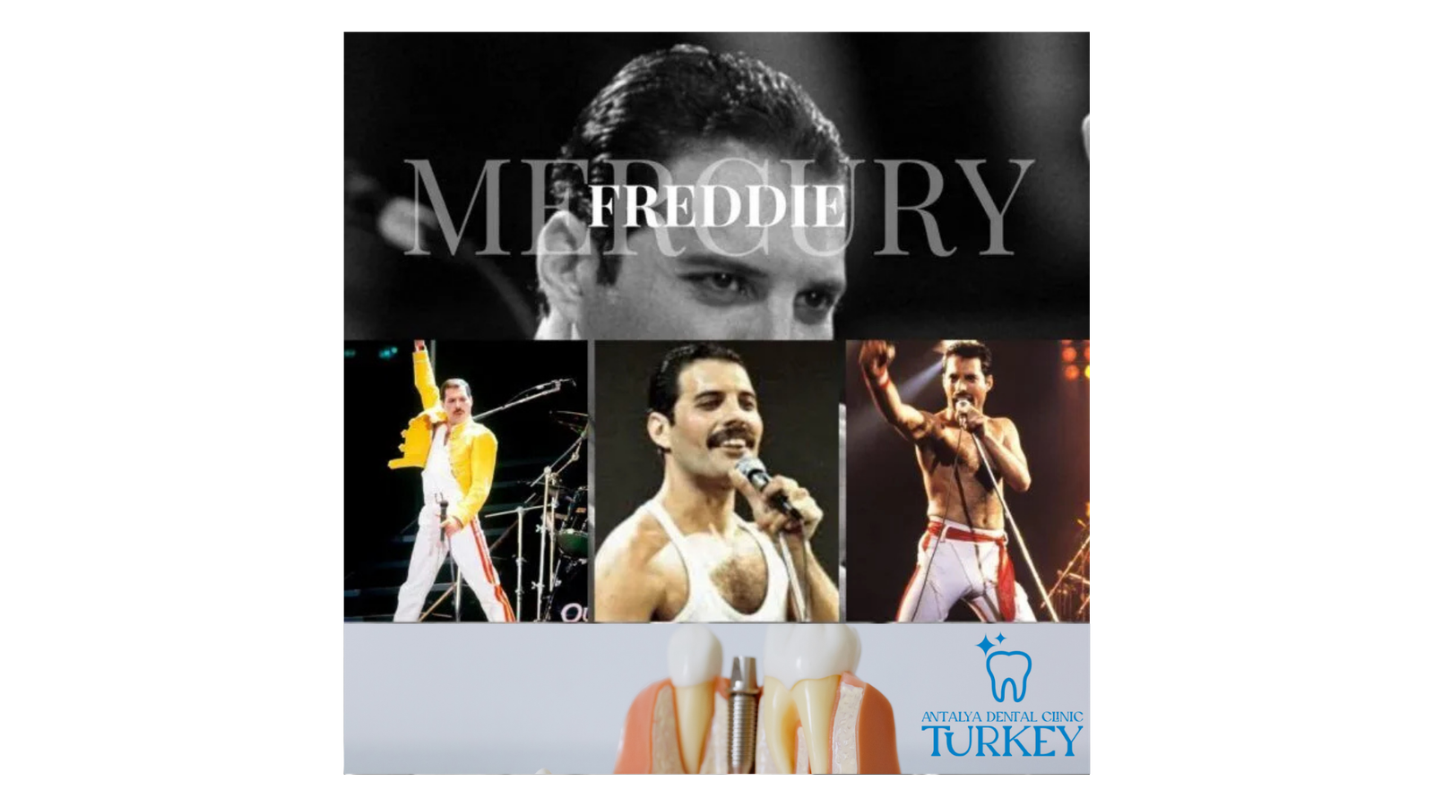 freddie mercury extra teeth