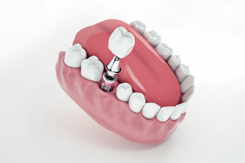 Top Dental Implants Turkey Packages: What's Included?