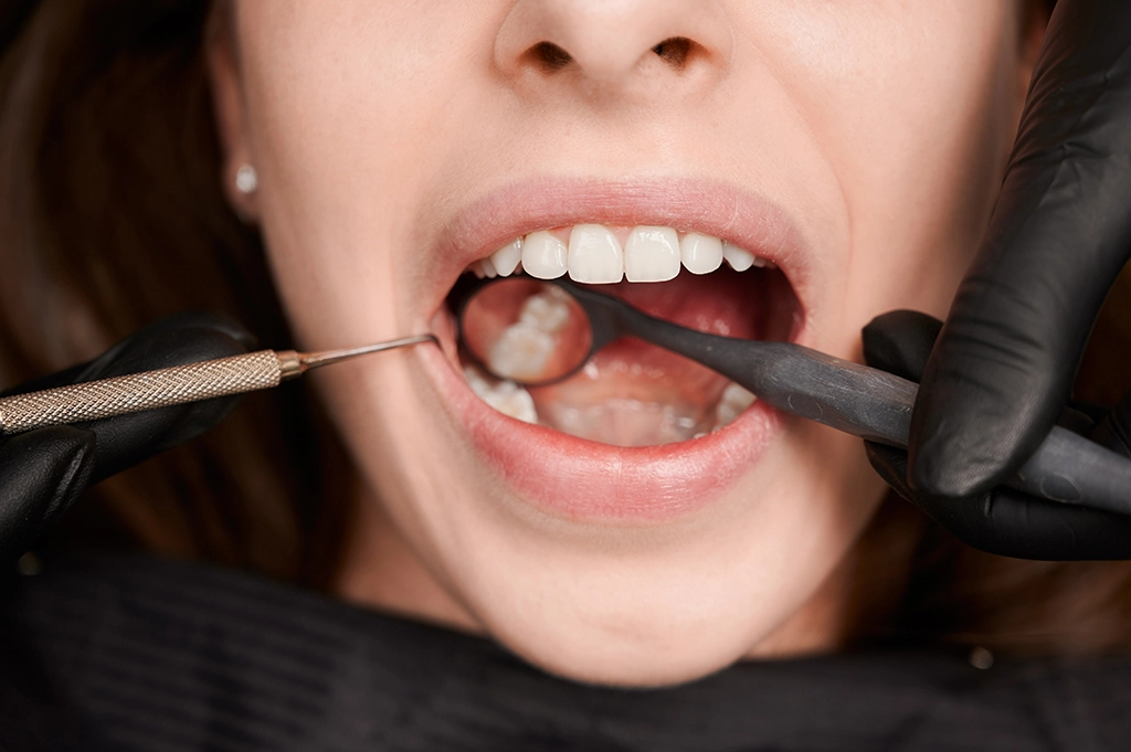 Tooth Removal Cost UK vs. Turkey: How to Save Up to 70% in Antalya