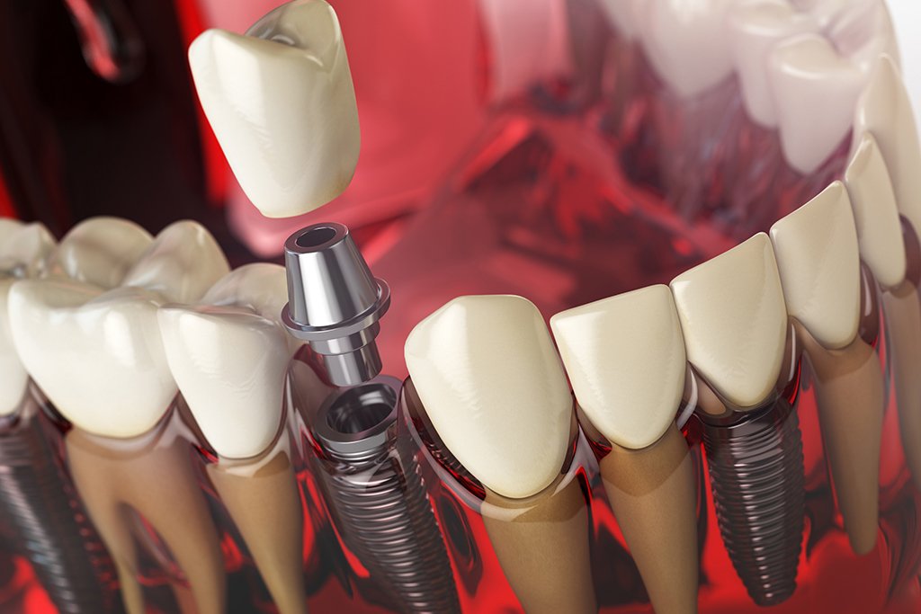 All on 4 Dental Implants in Turkey – Permanent Smile Restoration