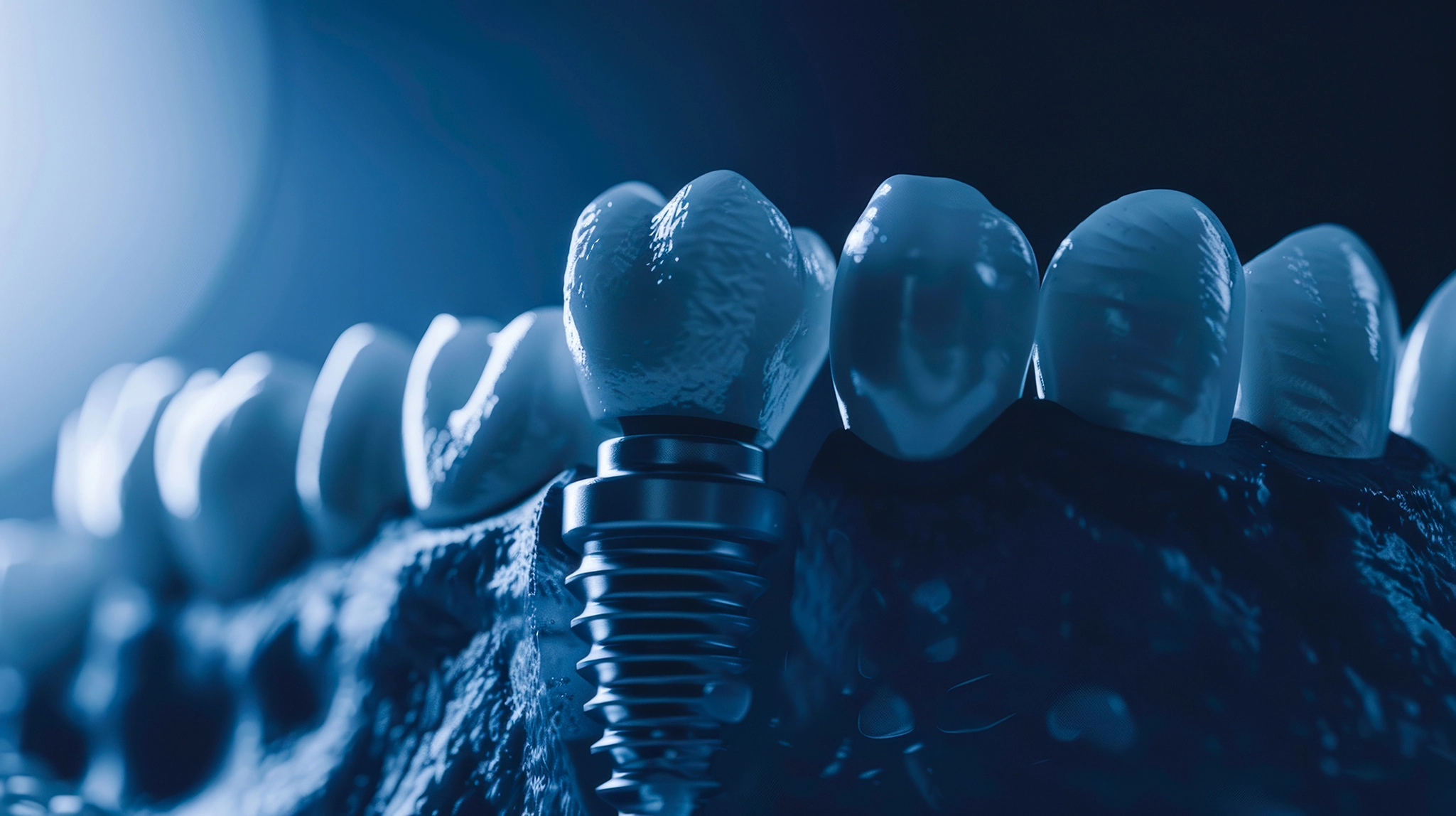Dental Implants