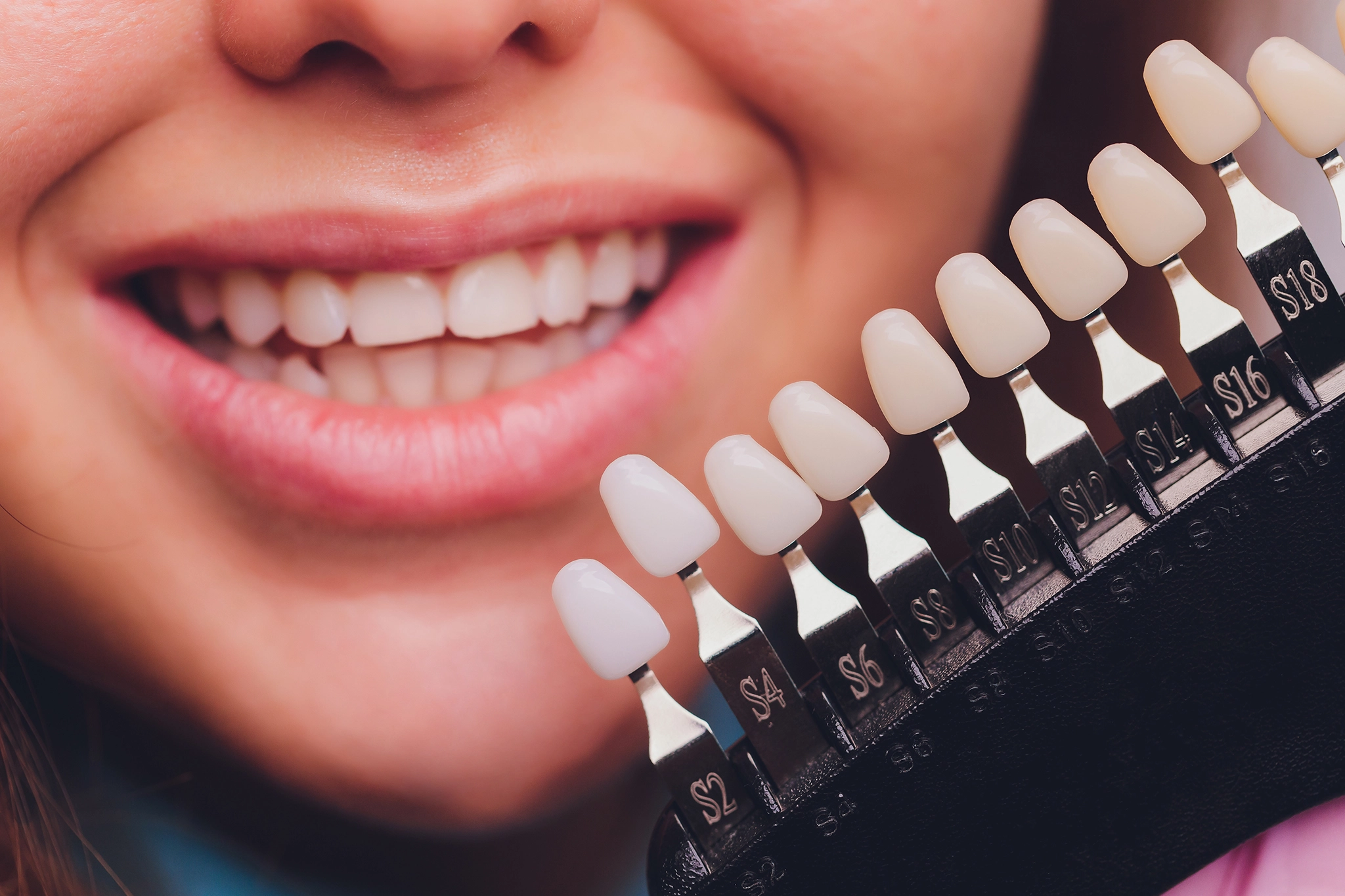 Dental Veneers