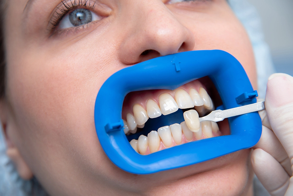 Dental Crowns