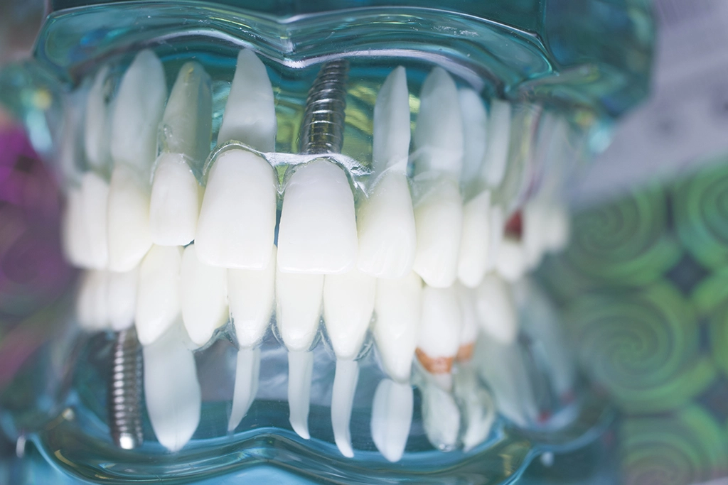 All-on-4/6® Dental Implants