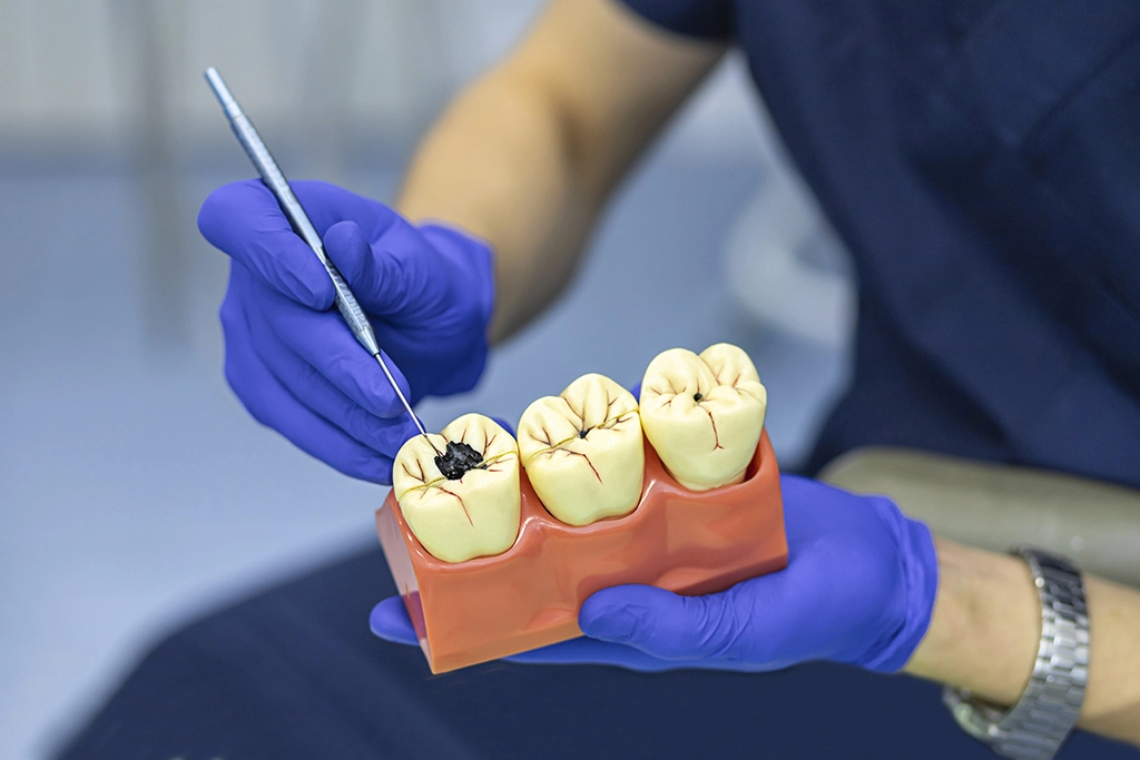 Dental Fillings