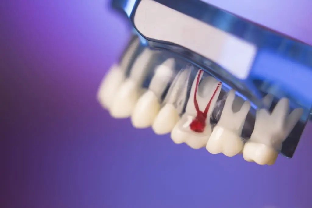 Bone Grafting