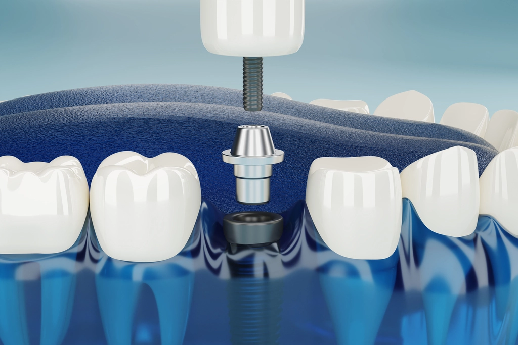 Non-Surgical Dental Implant
